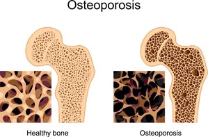 https://www.primarycareofappleton.com/getmedia/22445d62-f400-4662-ab38-2f70d7a0a5b2/Osteoporosis_small-(2)?width=299&height=197