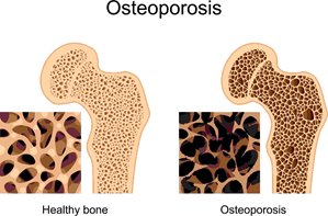 Osteoporosis
